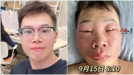 33歲帥男「腫漲式毀容」只因做這件事感染　網驚：每天都會做的事