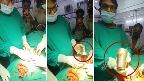 喝醉酒肚痛炸！他被推入手術房「挖出大鋼杯」…醫研判：從後面進去的