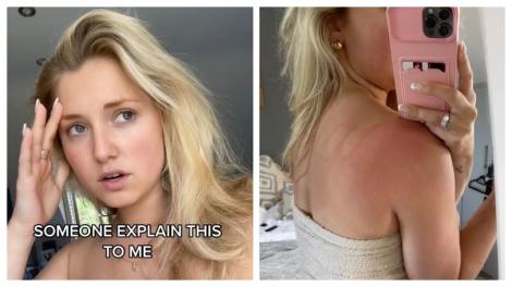 洗完澡後冒鬼手印！女露香肩嚇壞求助　網友解答她尬笑