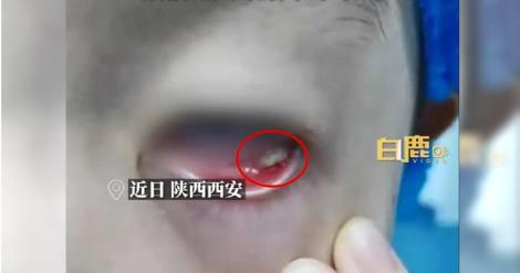 超恐怖！7歲男童和貓玩　貓毛入眼竟長出「這東西」只能開刀了