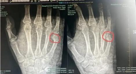 一道題講半小時！爸爸生氣了　一拳搥在桌子上…結果自己骨折了