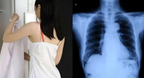 妹子照X光！男醫生提要求「上衣脫光光」　她火大投訴…醫院這樣說