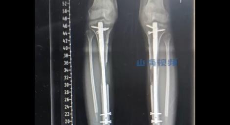 19歲妹子嫌自己太矮！竟「斷骨增高」下場超慘　醫：致殘率高